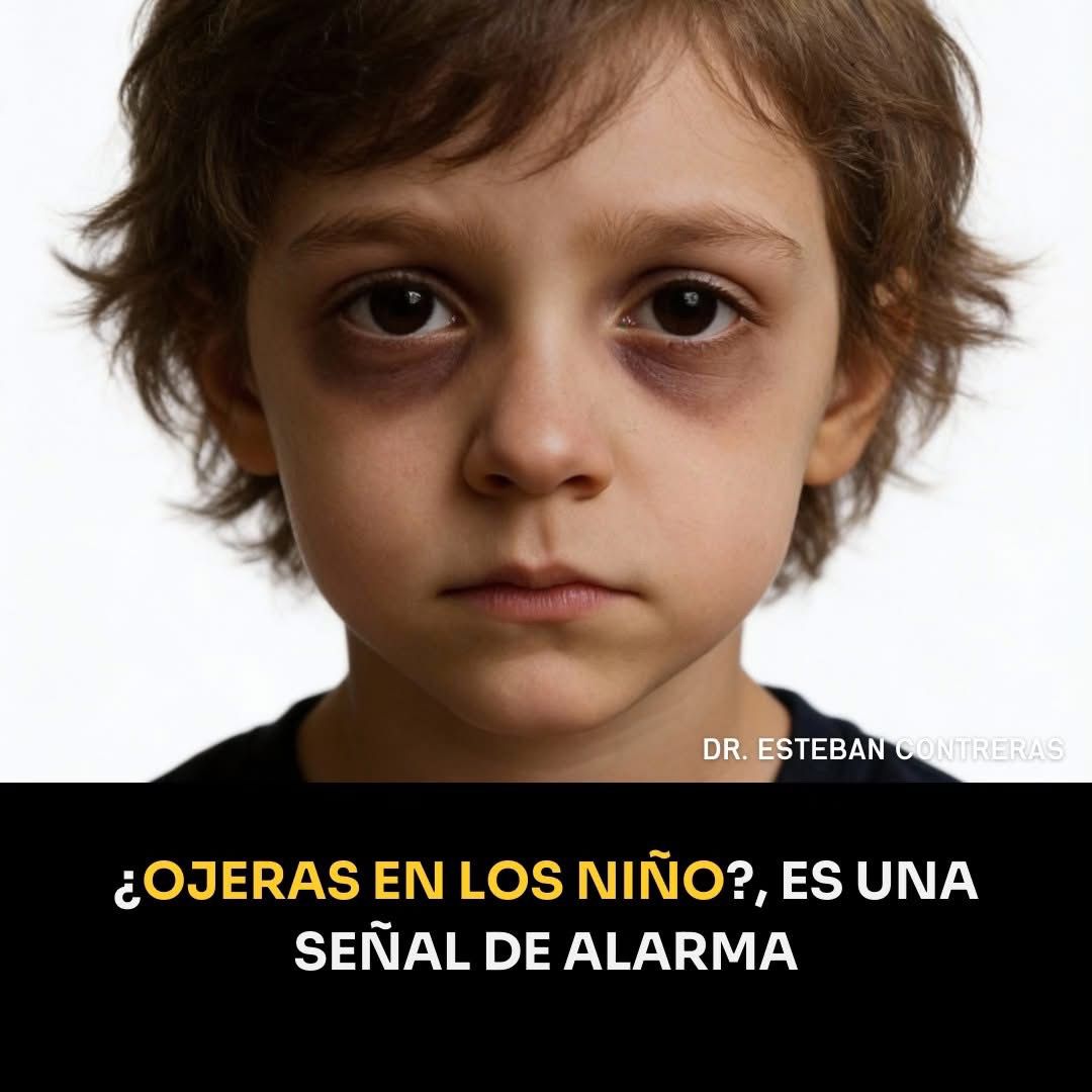 Ojeras marcadas en un niño que duerme bien… no siempre es falta de sueño.