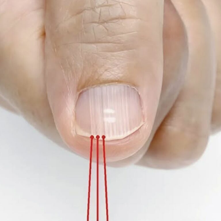 Lo que realmente revelan esas líneas verticales en tus uñas
